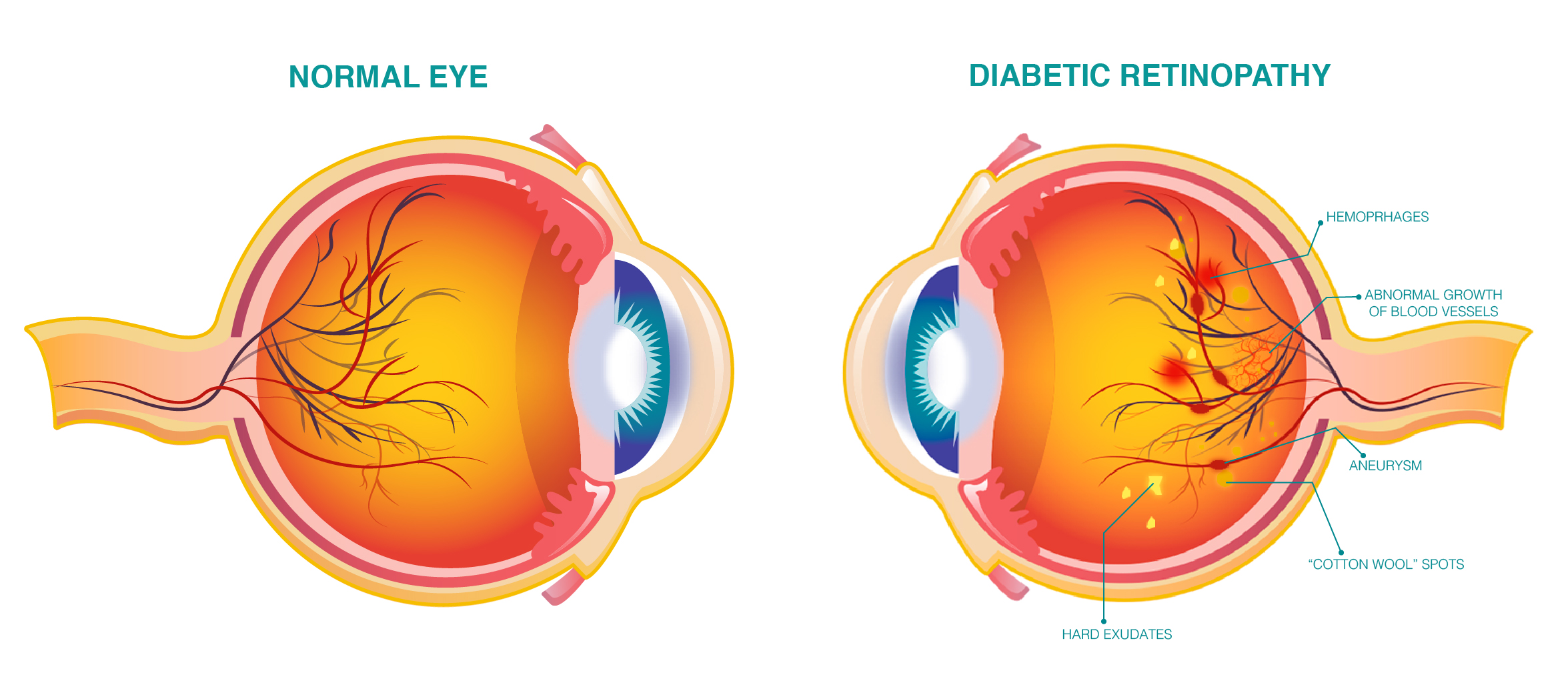 Diabetic Retinopathy vision loss Treatment In Ayurveda Normal Vision Blurred Vision dark floaters regular eye check-up eye issues